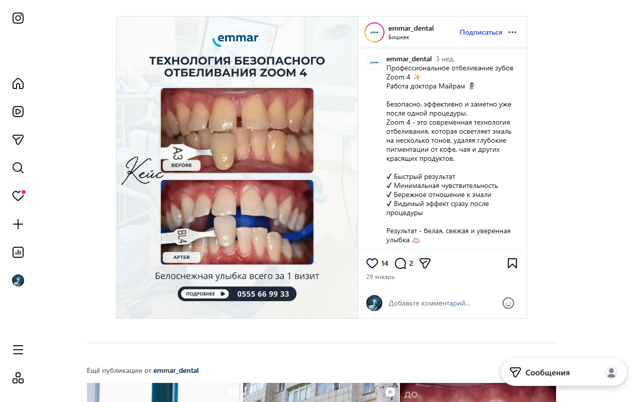 Отбеливание Zoom 4 до и после — результат за один визит