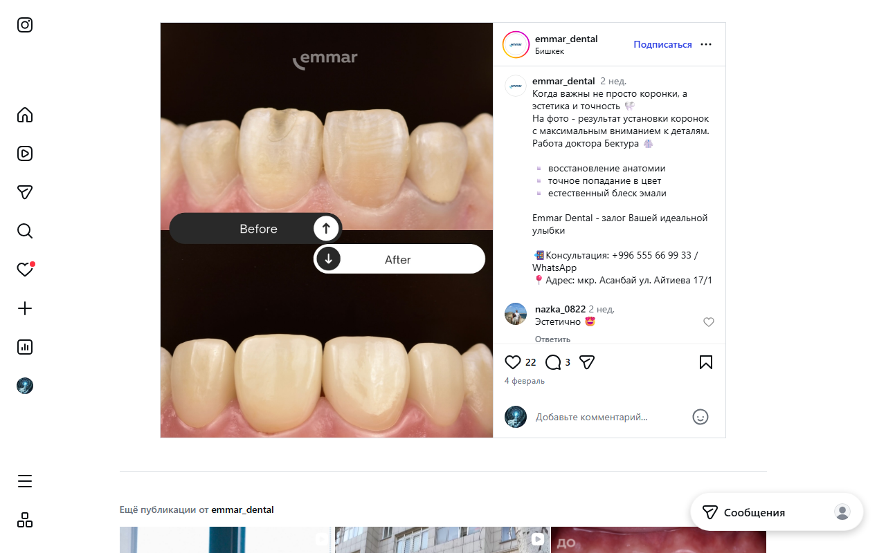 Установка коронок до и после — ортопедия в Emmar Dental