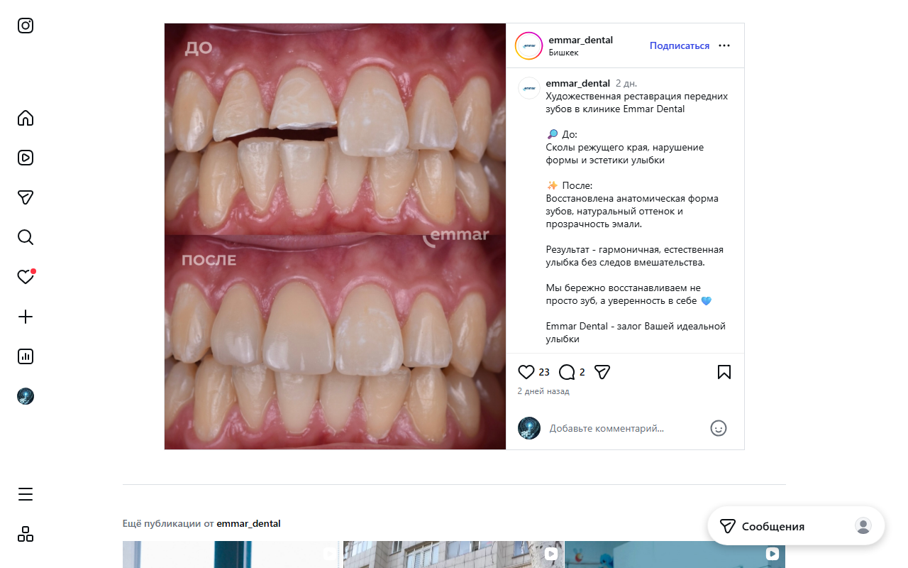 Художественная реставрация передних зубов — результат работы Emmar Dental