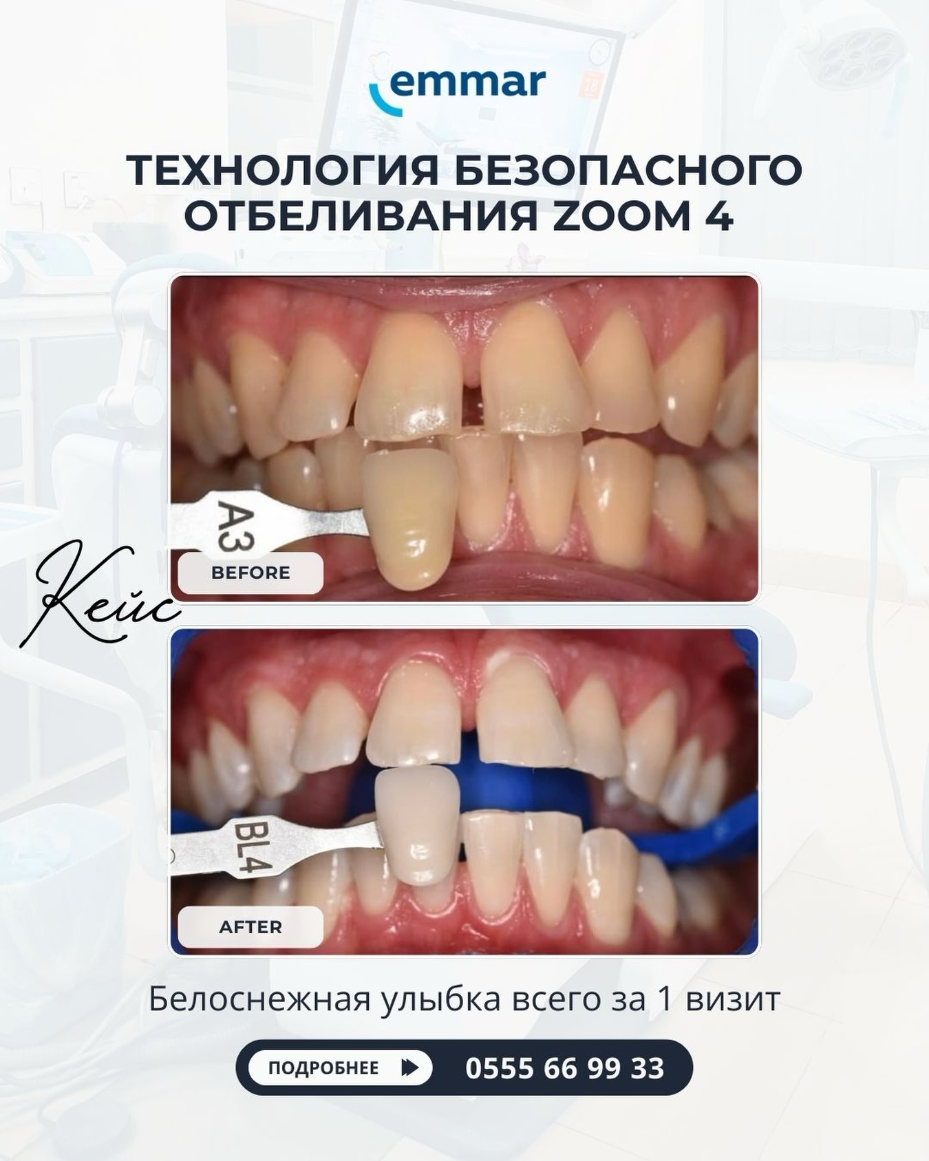 Отбеливание Zoom 4