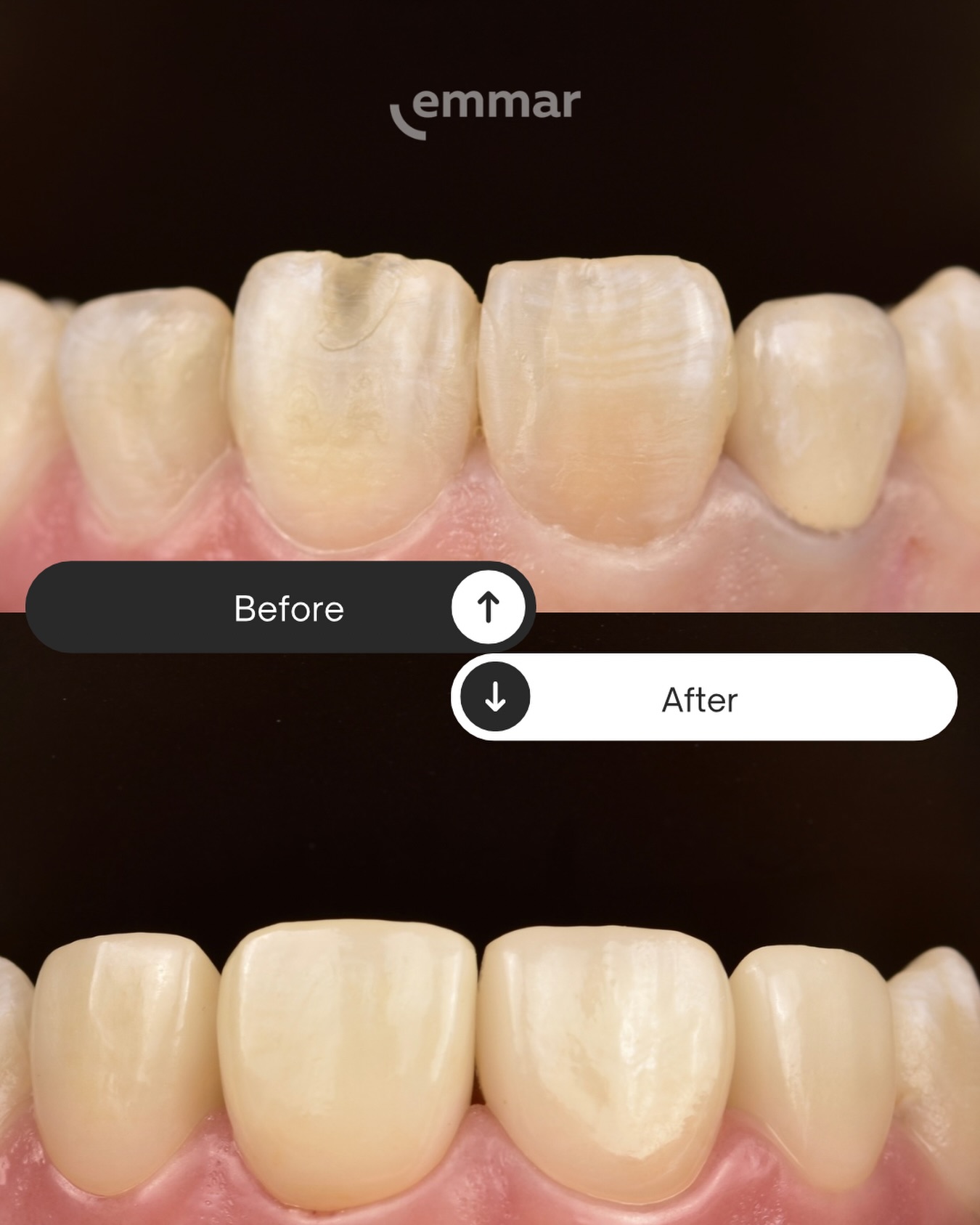 Установка коронок