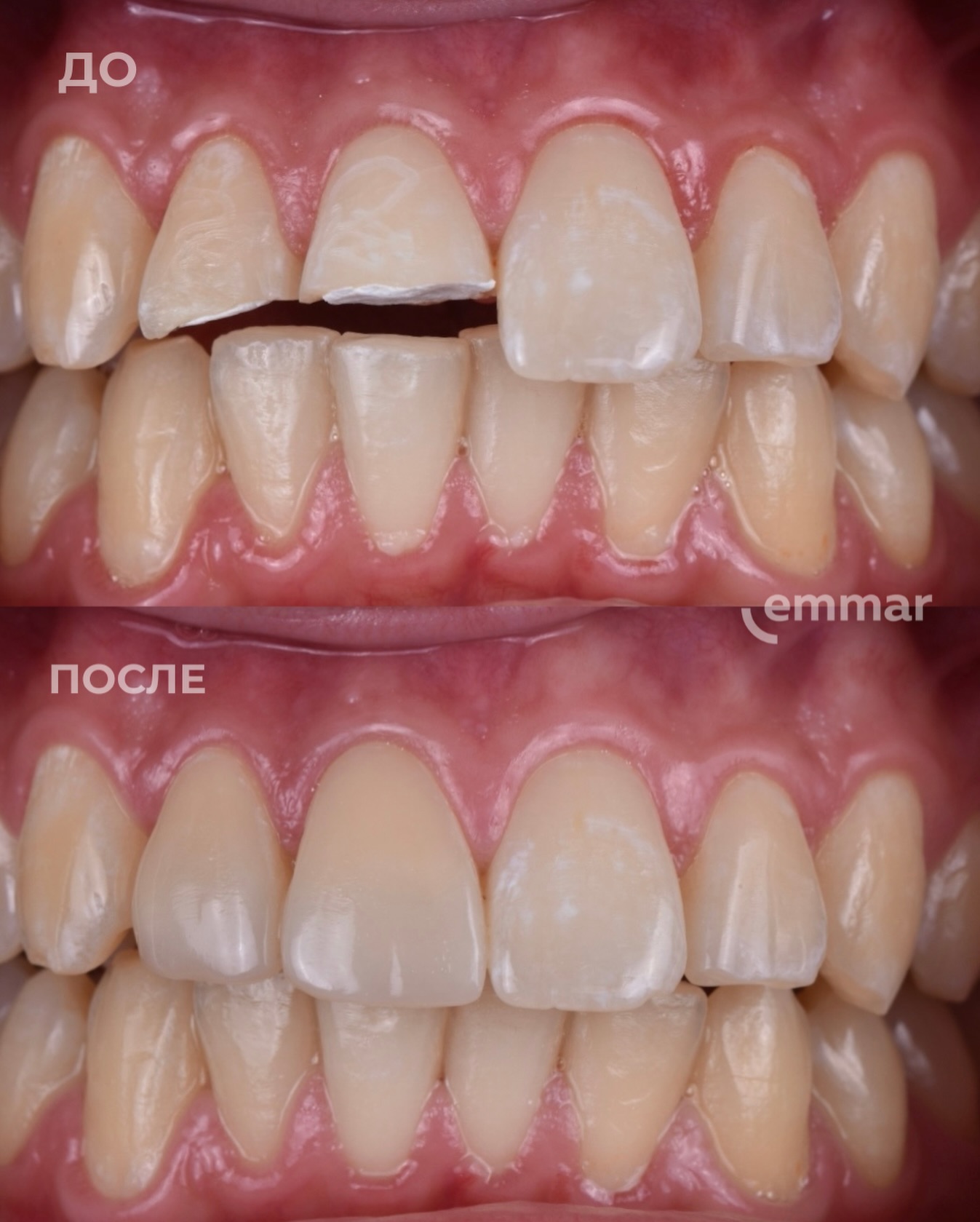 Результат художественной реставрации зубов в Emmar Dental